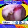 Contemporary Endoscopic Spine Surgery – Cervical Spine: Volume 1