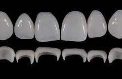 Prosthetic Rehabilitation on Natural Teeth: Predictable, Esthetic and Systematic Steps
