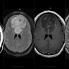MRIOnline Imaging Mastery Series: Adult Glioma Imaging 2021 (CME VIDEOS)