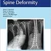 Neuromuscular Spine Deformity (EPUB)