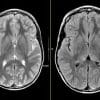 MRIOnline Mastery Series: Neurofibromatosis Type 1 (NF1) 2021 (CME VIDEOS)