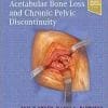 Treatment of Acetabular Bone Loss and Chronic Pelvic Discontinuity (PDF)