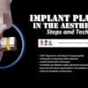 OHI-S Implant Placement in the Aesthetic Zone: Steps and Technique (Course)