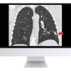 Tumor Imaging: Lung Cancer (Course)